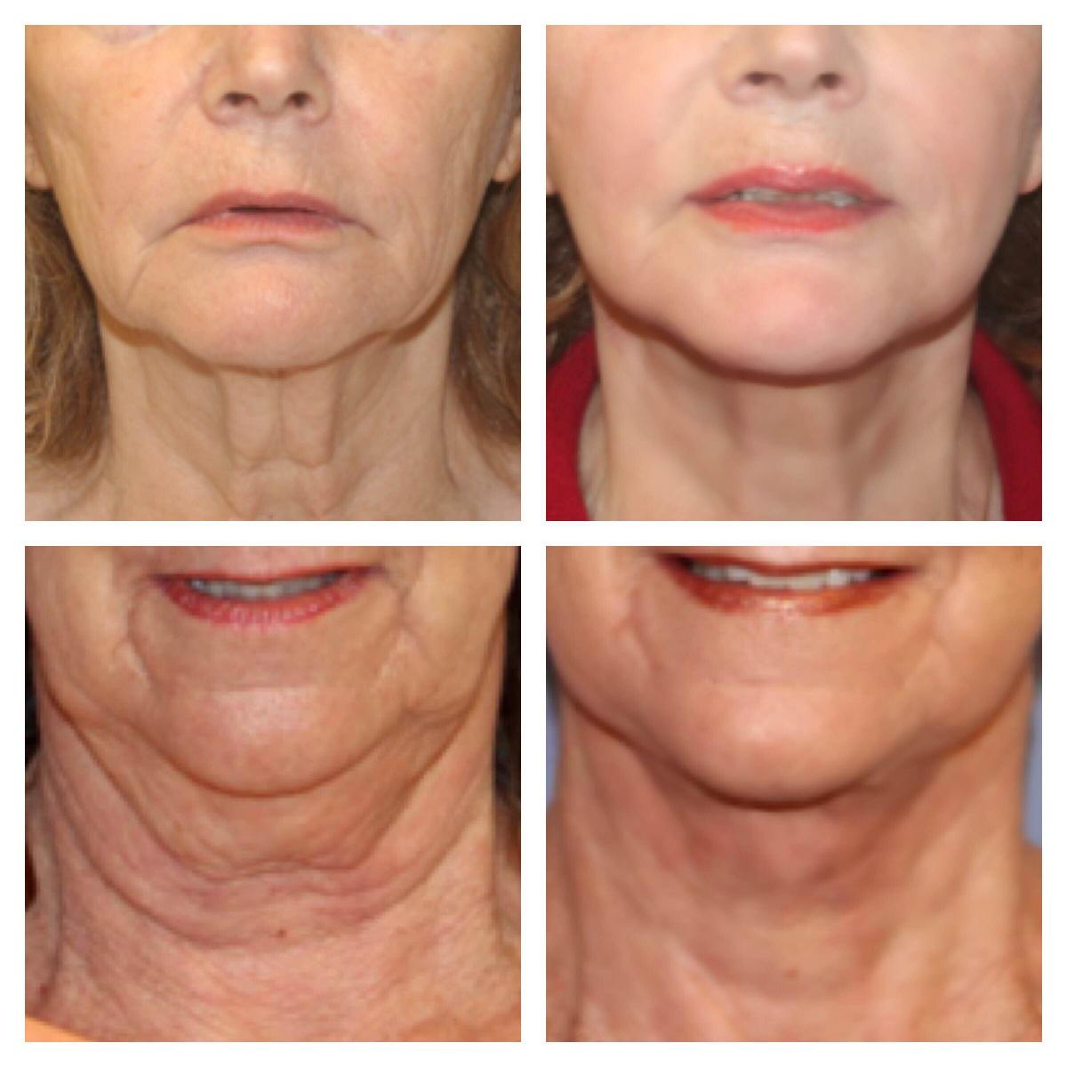 New Neck Cream Firming Best Anti Aging Lift Tightening