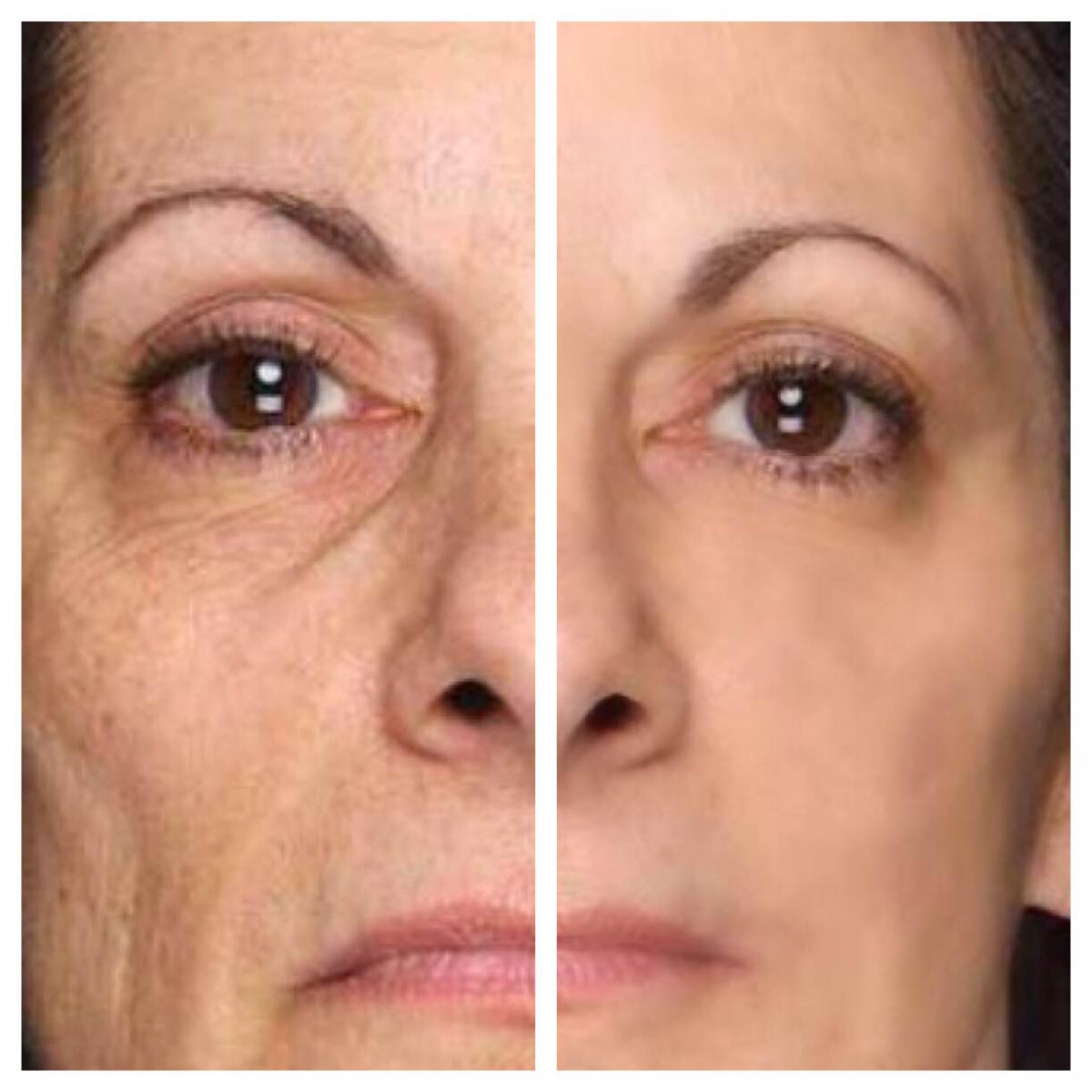 Matrixyl 3000 Peptide Cream Hyaluronic Acid Wrinkle Collagen Advanced